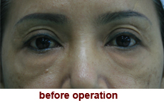 plastic-surgery-blepharoplasty